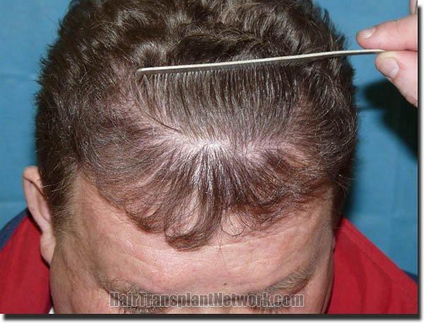 Hair restoration procedure results