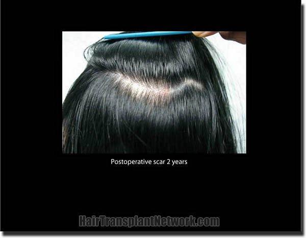 Hair restoration procedure results