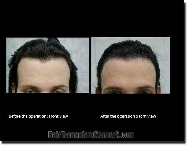 Hair restoration procedure results