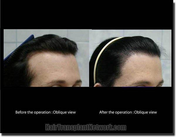 Hair restoration procedure results