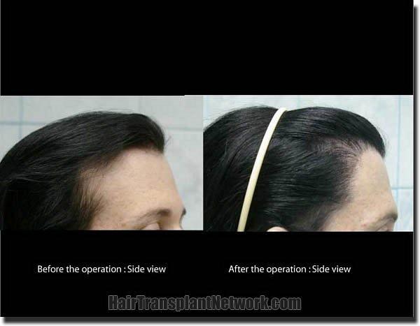 Hair restoration procedure results