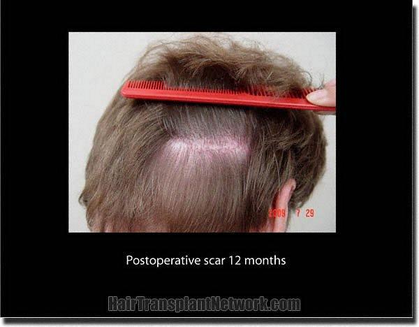 Hair restoration procedure results