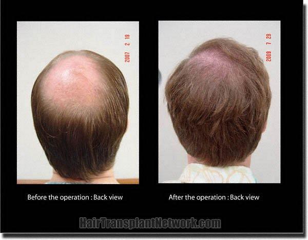 Hair restoration procedure results