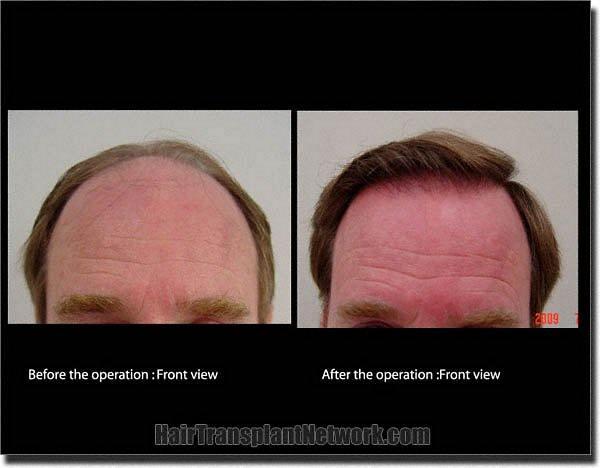 Hair restoration procedure results