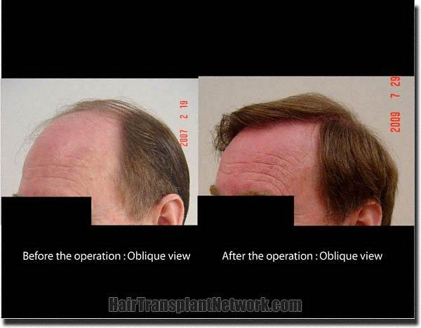 Hair restoration procedure results