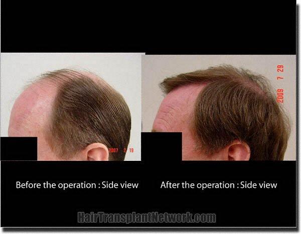 Hair restoration procedure results