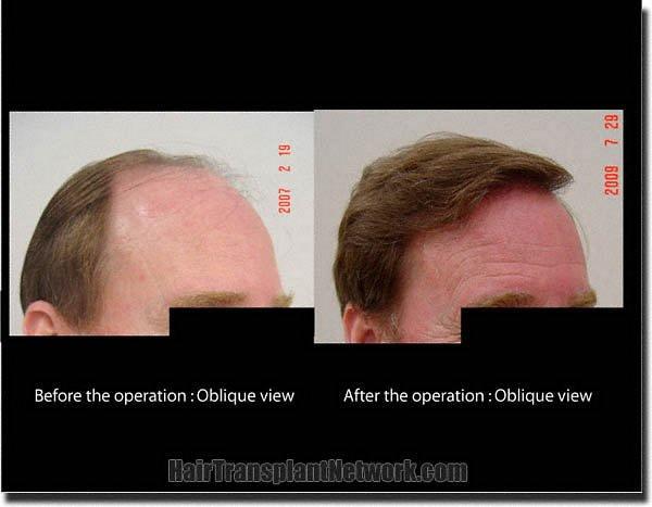 Hair restoration procedure results