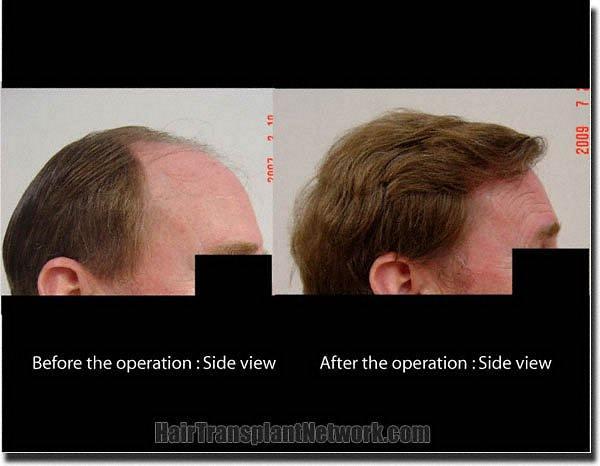 Hair restoration procedure results