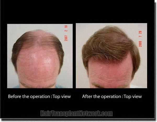 Hair restoration procedure results