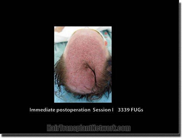 Hair restoration procedure results