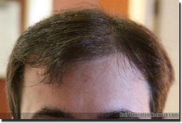 Hair restoration procedure results