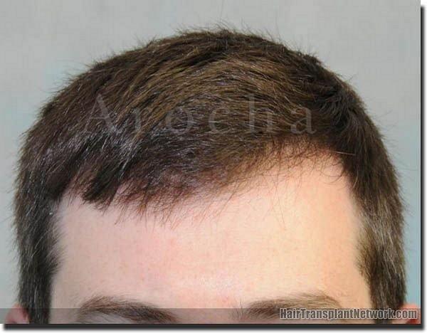 Hair restoration procedure results