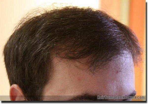 Hair restoration procedure results