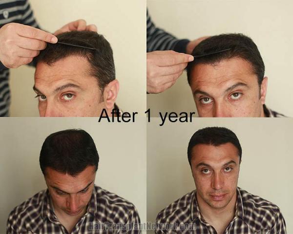 Hair restoration procedure before and after result photographs