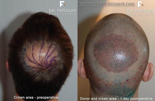 Hair transplantation surgery before and after pictures