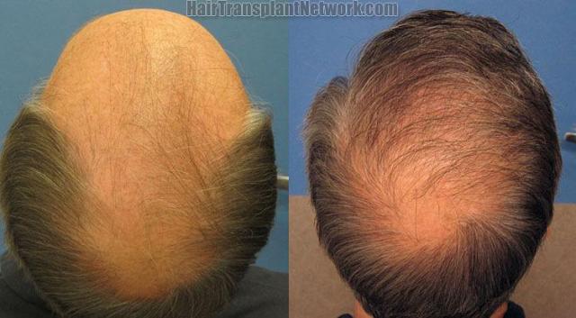 Patient crown photos before and after hair replacement
