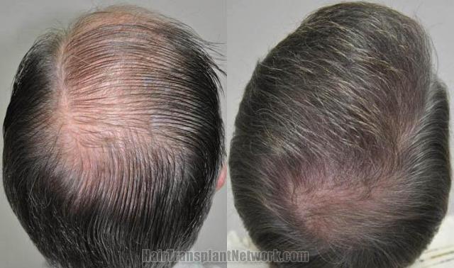 Hair restoration procedure before and after pictures