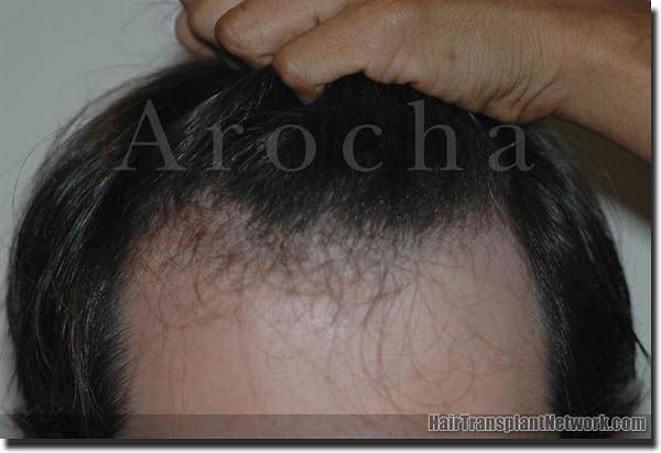 Hair restoration procedure results