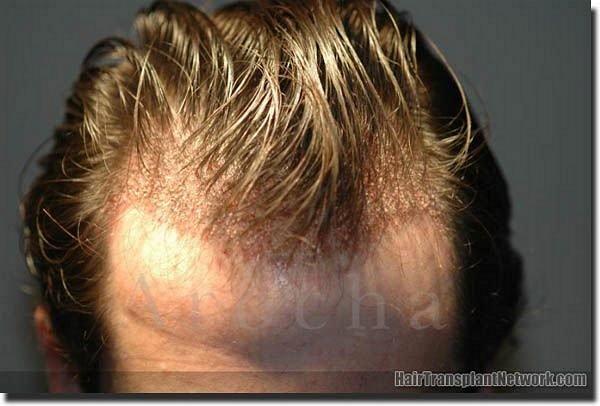 Hair restoration procedure results