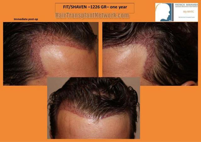 Hair restoration procedure before and after pictures