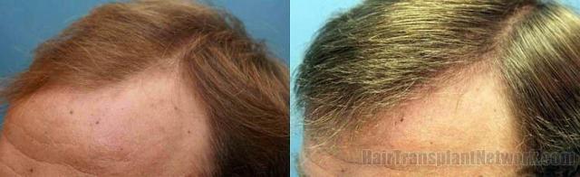 Hair transplant results viewed from left