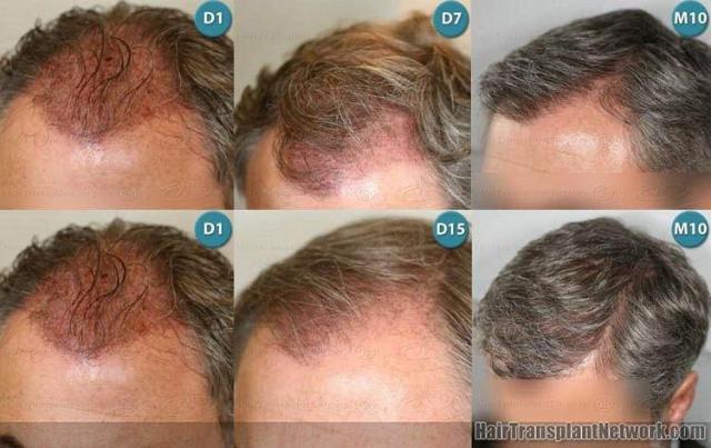 Left side pictures displaying hair transplant results