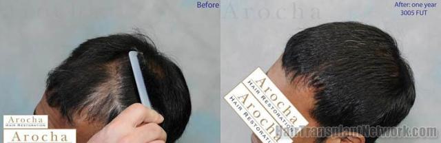 Hair transplantation surgery before and after pictures