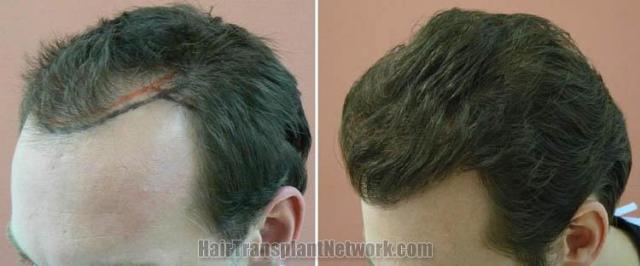 Hair restoration procedure before and after results