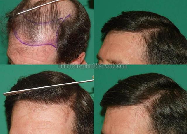 Hair transplantation surgery before and after photos