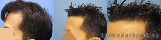 hair transplant results showing left views.