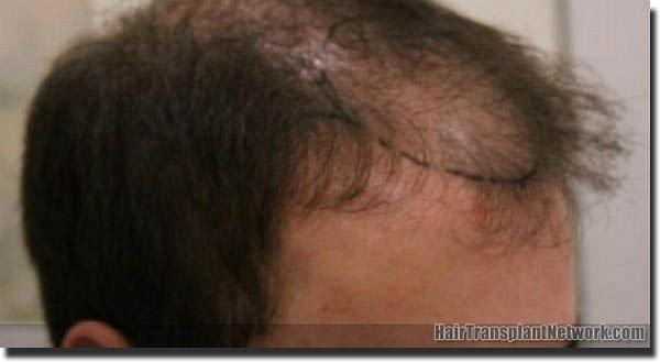 Hair restoration procedure results