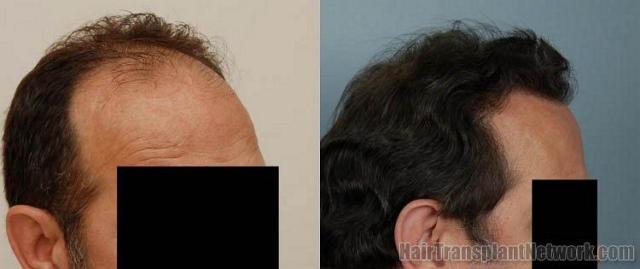 Hair replacement  - Before and after right side