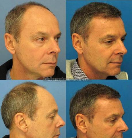 Right view - Before and after hair transplantation