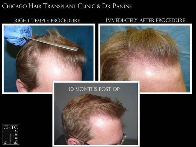 Hair transplantation surgery before and after photos