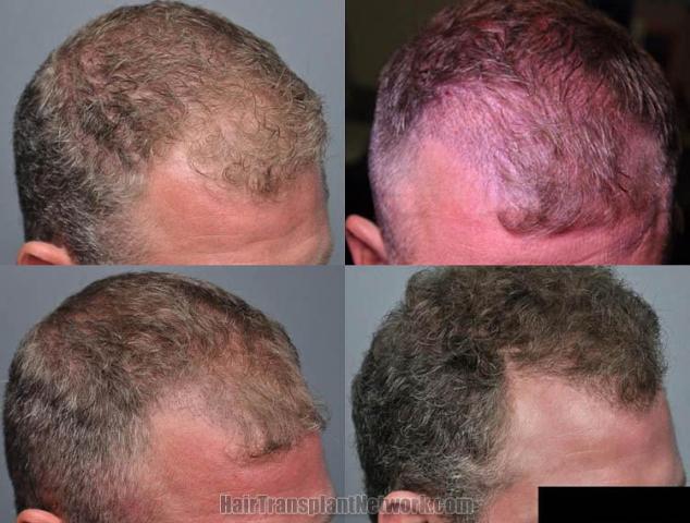 Hair transplantation surgery before and after images