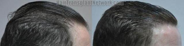 Hair transplantation surgery before and after photos