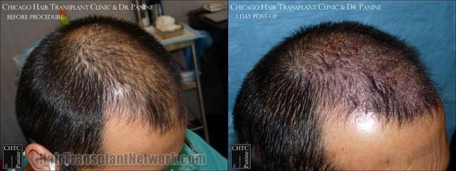 Hair transplantation surgery before and after photos