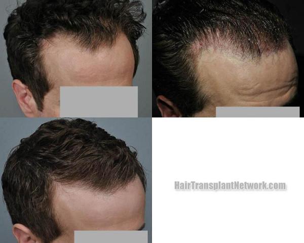 Hair transplantation surgery before and after images