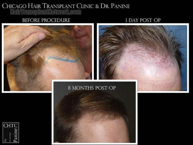 Hair transplantation surgery before and after images