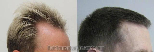 Hair transplantation surgery before and after images