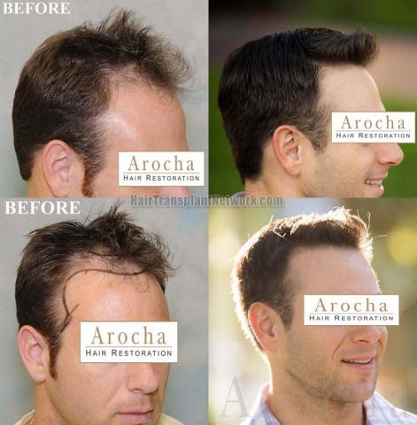 Hair transplantation surgery before and after images