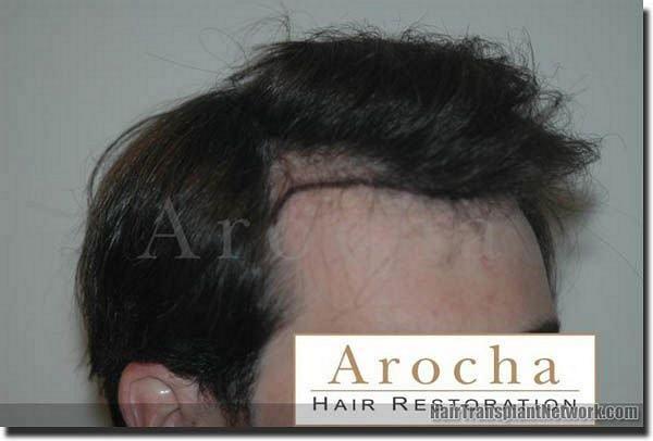 Hair restoration procedure results