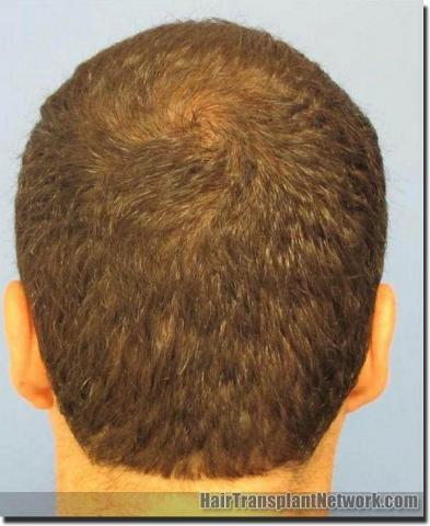 Hair restoration procedure results