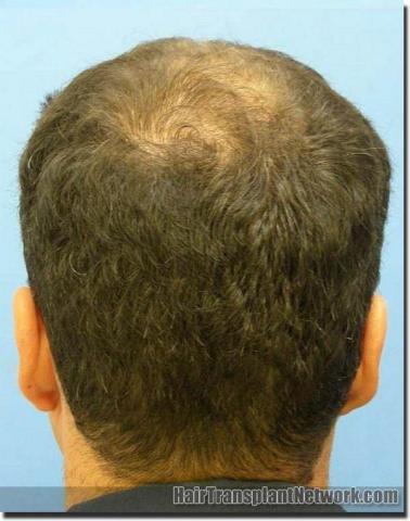 Hair restoration procedure results