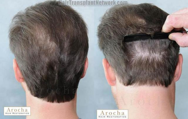 Hair transplantation surgery before and after pictures