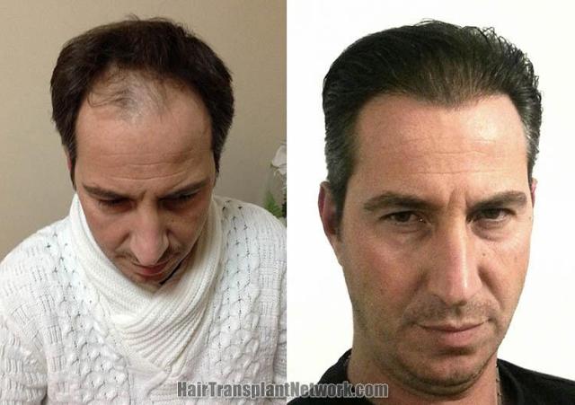 Front view - Before and after hair transplant surgery result images