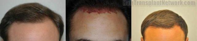 Hair transplant procedure before and after photos 