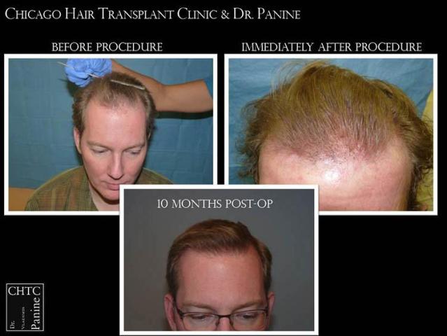 Hair restoration procedure before and after results