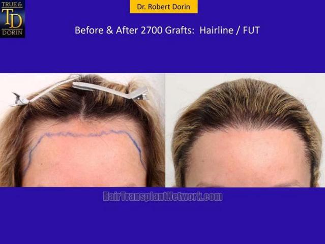 Dr Robert Dorin Female Hair Restoration Surgery Before And After Images With 2700 Grafts