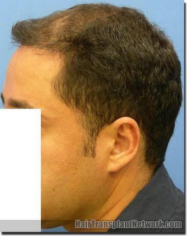 Hair restoration procedure results